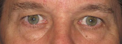 Eyelid Surgery (Blepharoplasty) Before & After Gallery - Patient 341265 - Image 1