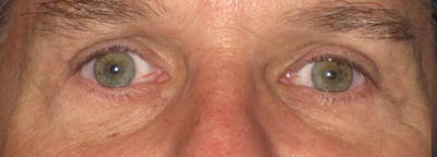 Eyelid Surgery (Blepharoplasty) Before & After Gallery - Patient 341265 - Image 2