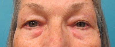 Eyelid Surgery (Blepharoplasty) Before & After Gallery - Patient 207335 - Image 1