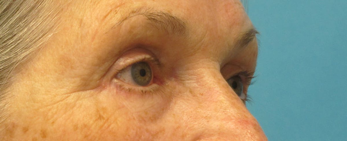 Eyelid Surgery (Blepharoplasty) Before & After Gallery - Patient 207335 - Image 4