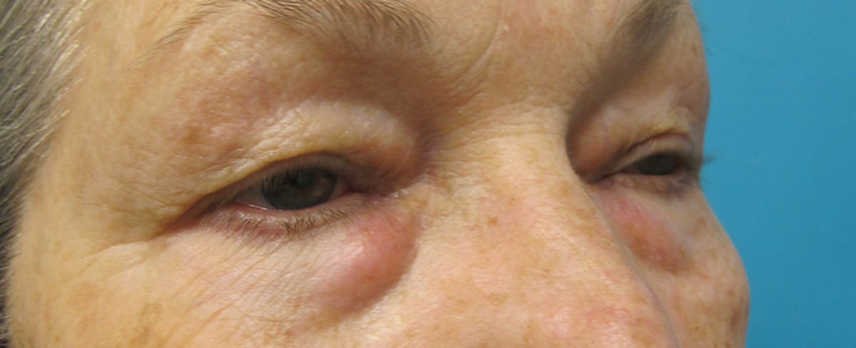 Eyelid Surgery (Blepharoplasty) Before & After Gallery - Patient 207335 - Image 3