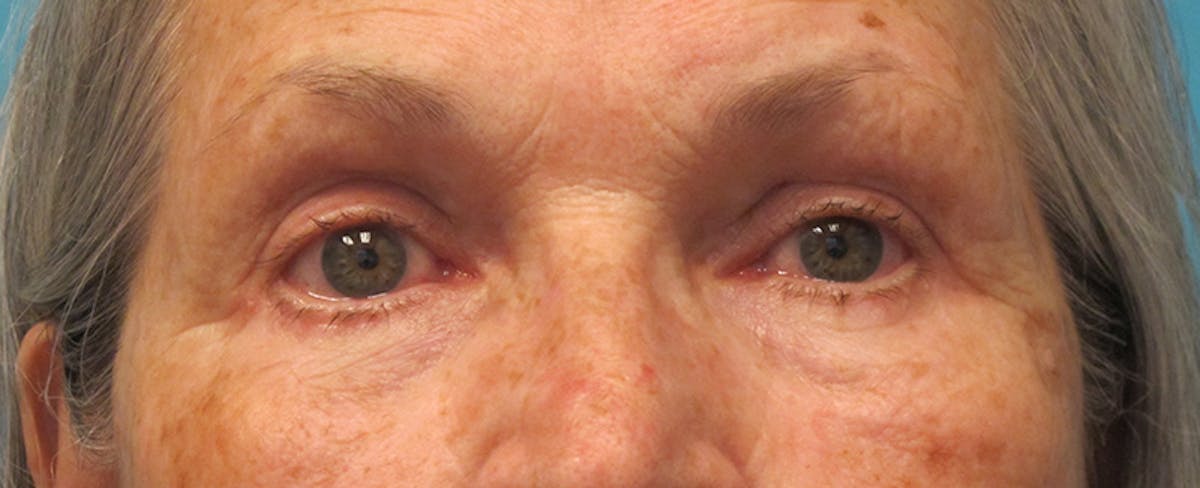 Eyelid Surgery (Blepharoplasty) Before & After Gallery - Patient 207335 - Image 2