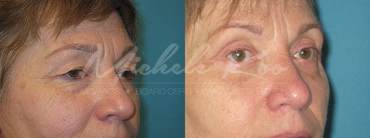 Eyelid Surgery (Blepharoplasty) Before & After Gallery - Patient 374588 - Image 2