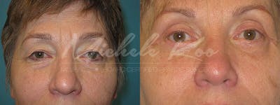 Eyelid Surgery (Blepharoplasty) Before & After Gallery - Patient 374588 - Image 1