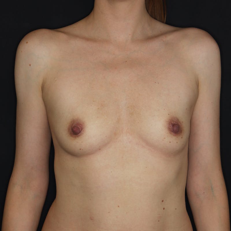 Preservé™ Breast Enhancement Before & After Gallery - Patient 722529 - Image 1