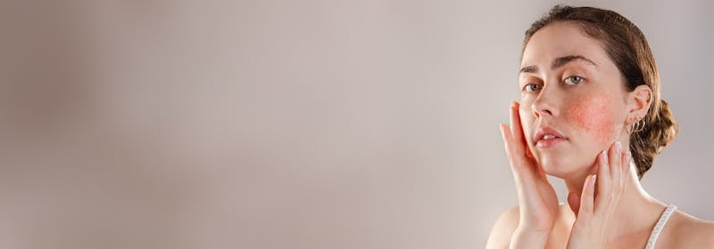 ProFractional® Laser Treatment for Rosace?