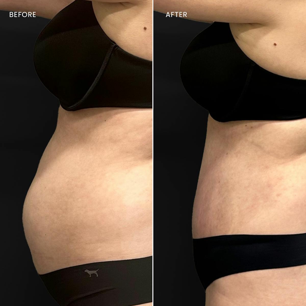 Tummy Tuck (Abdominoplasty) Before & After Gallery - Patient 190650 - Image 2