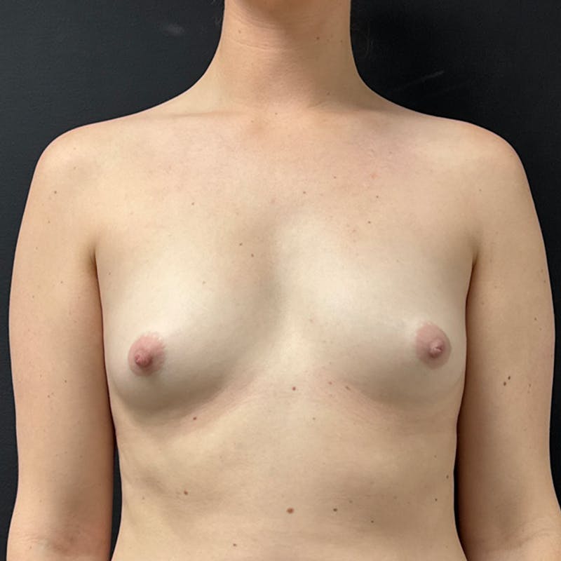 Preservé™ Breast Enhancement Before & After Gallery - Patient 759901 - Image 1