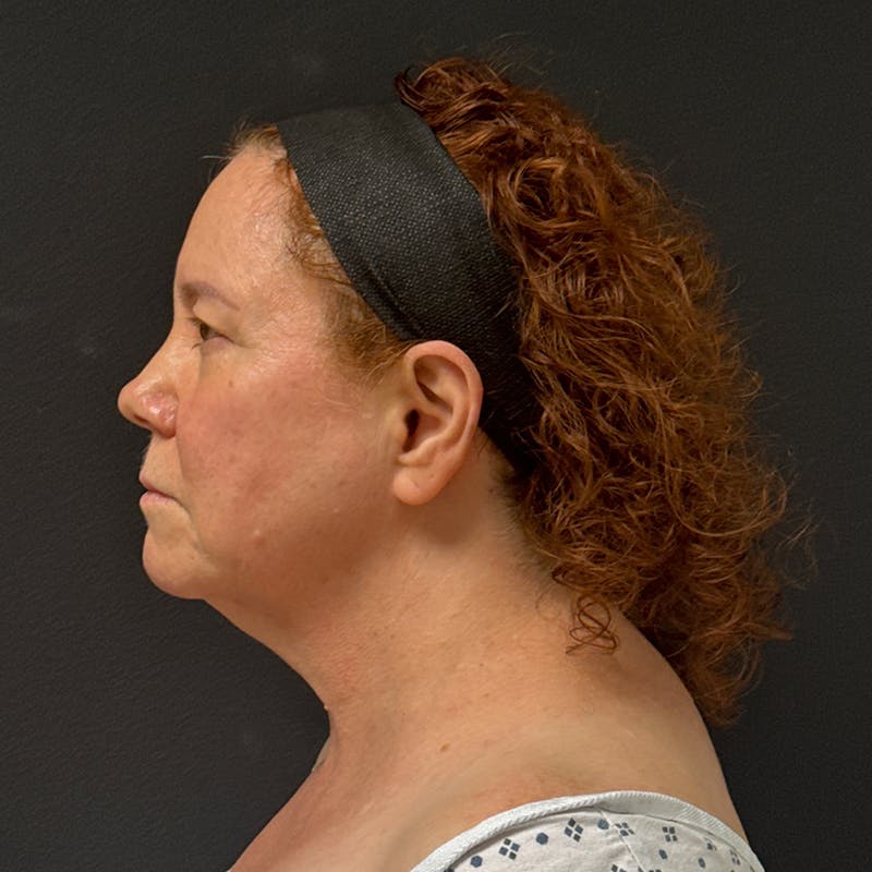 Facelift Before & After Gallery - Patient 278458 - Image 5