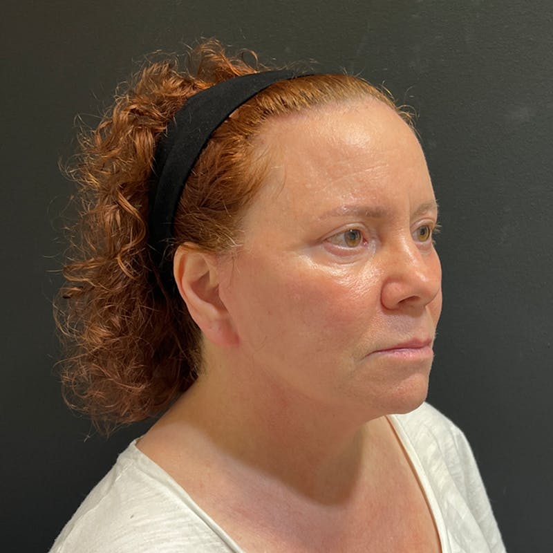 Facelift Before & After Gallery - Patient 278458 - Image 4