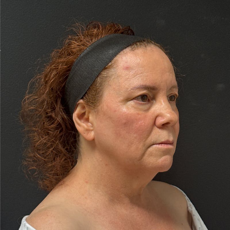 Facelift Before & After Gallery - Patient 278458 - Image 3