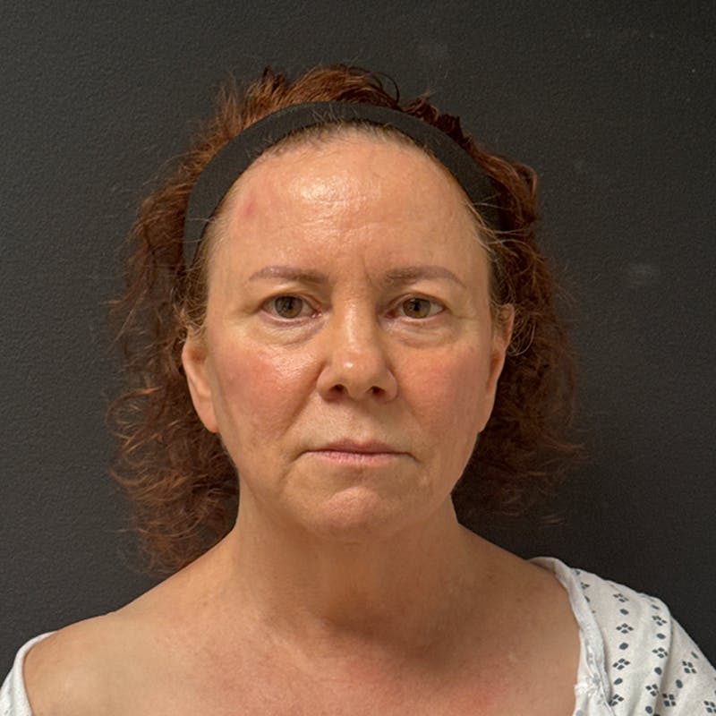 Facelift Before & After Gallery - Patient 278458 - Image 1