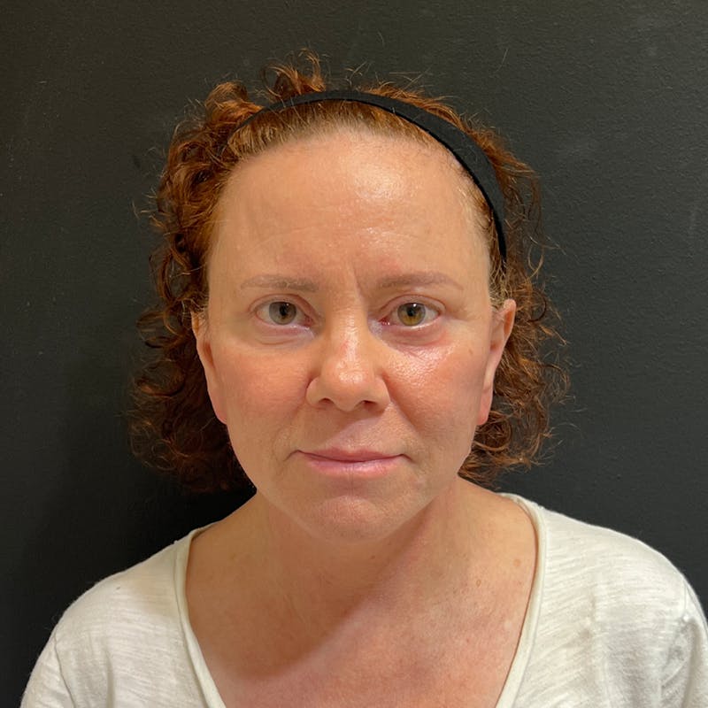 Facelift Before & After Gallery - Patient 278458 - Image 2