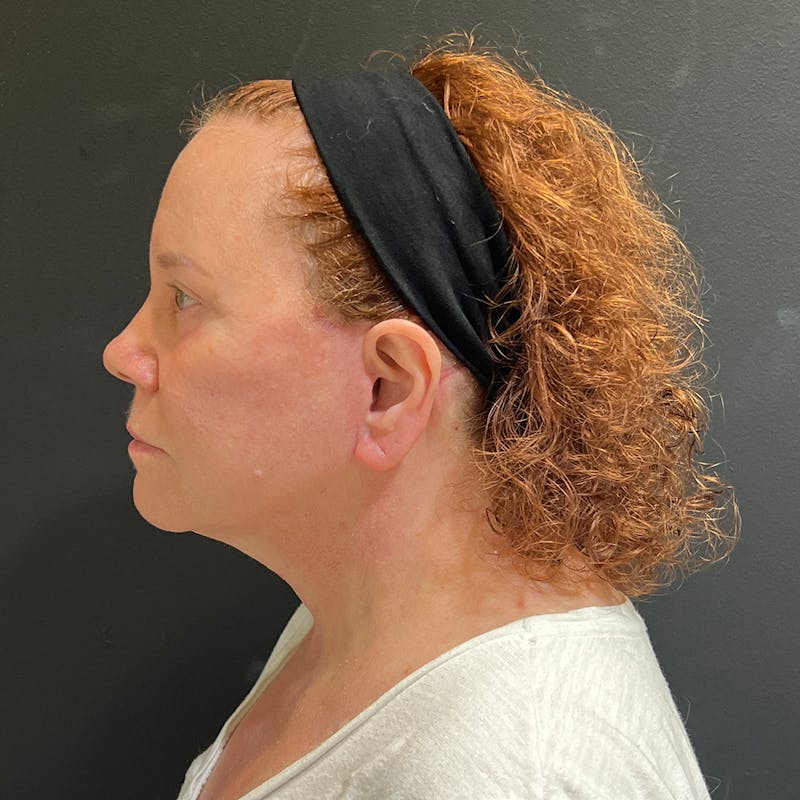 Facelift Before & After Gallery - Patient 278458 - Image 6