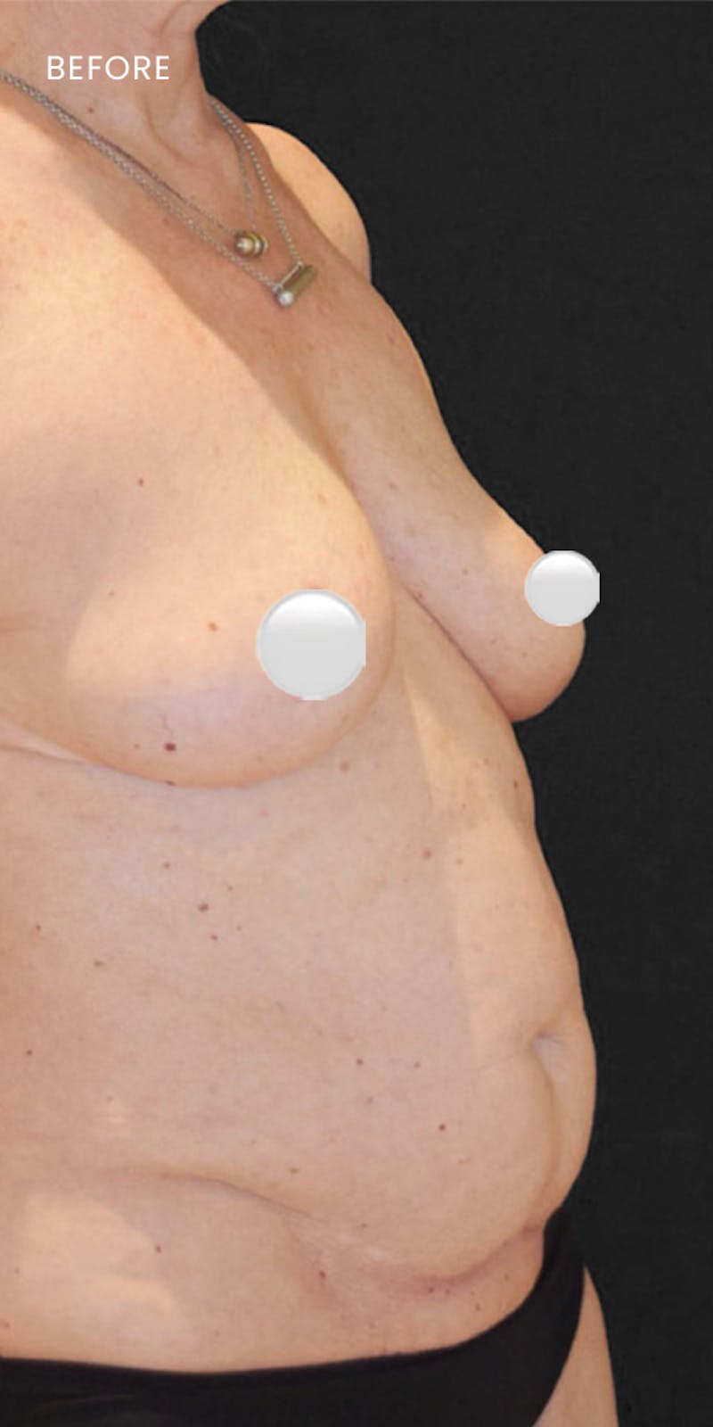 Tummy Tuck (Abdominoplasty) Before & After Gallery - Patient 116130 - Image 3