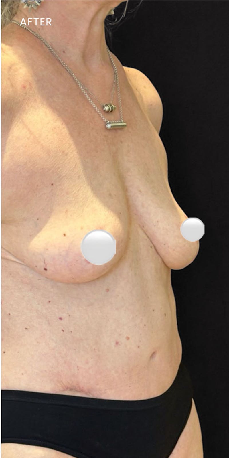 Tummy Tuck (Abdominoplasty) Before & After Gallery - Patient 116130 - Image 4