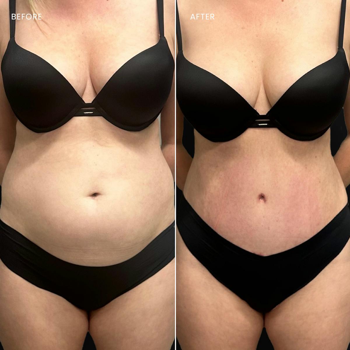 Tummy Tuck (Abdominoplasty) Before & After Gallery - Patient 190650 - Image 1