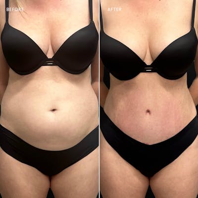 Tummy Tuck (Abdominoplasty) Before & After Gallery - Patient 190650 - Image 1