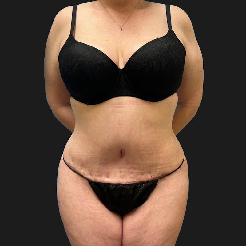 Tummy Tuck (Abdominoplasty) Before & After Gallery - Patient 847749 - Image 2