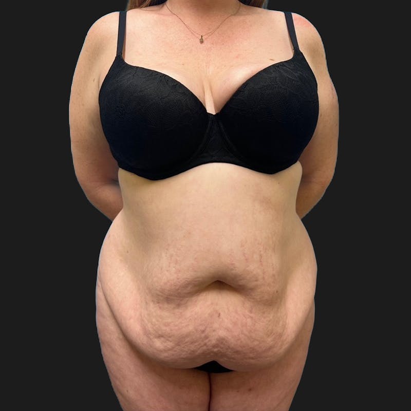 Tummy Tuck (Abdominoplasty) Before & After Gallery - Patient 847749 - Image 1