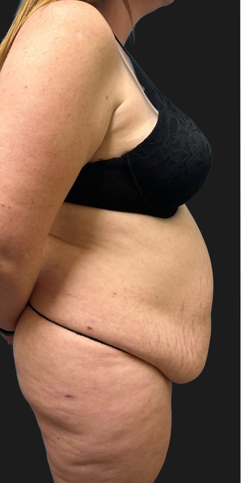 Tummy Tuck (Abdominoplasty) Before & After Gallery - Patient 847749 - Image 3