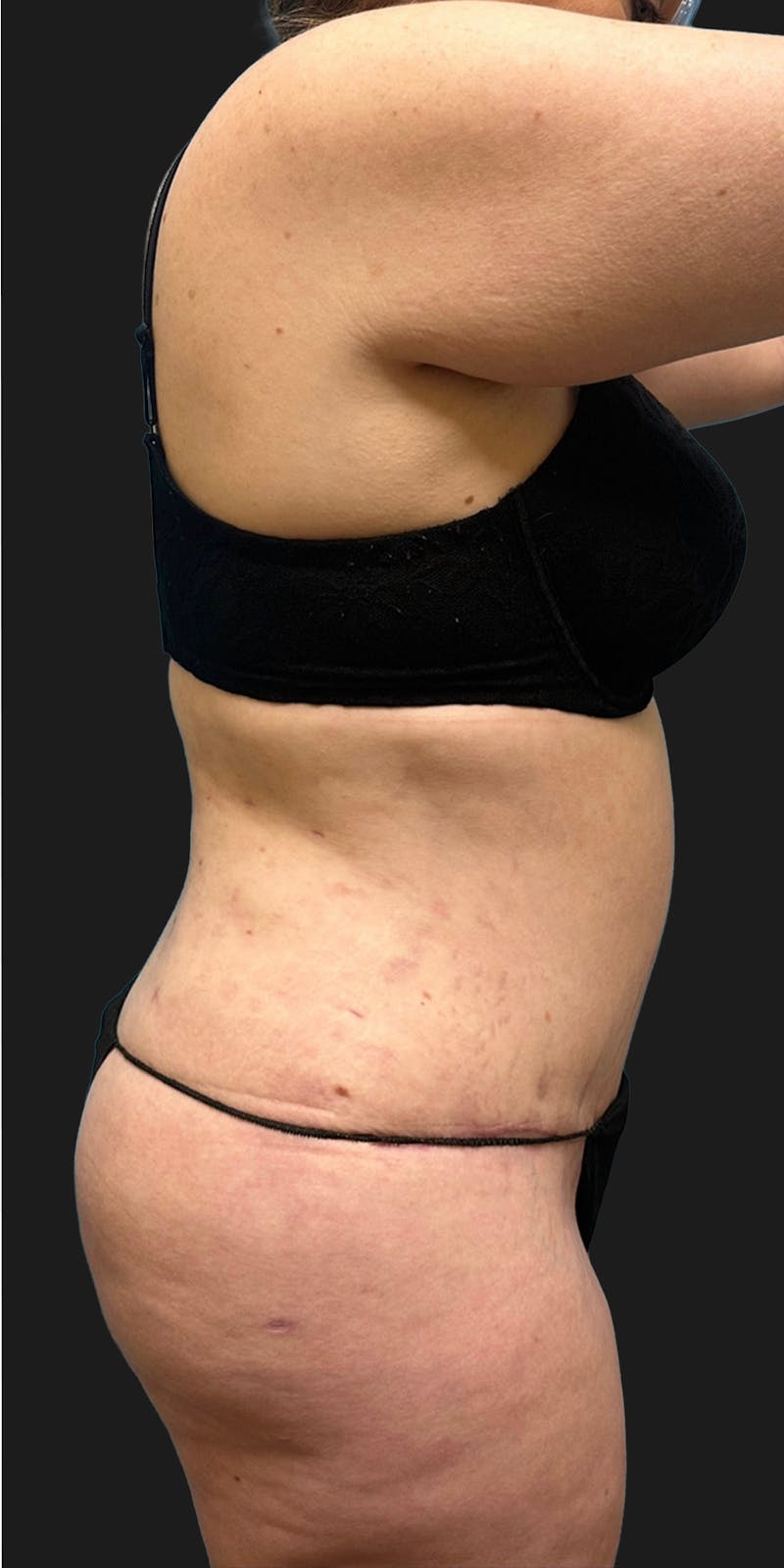 Tummy Tuck (Abdominoplasty) Before & After Gallery - Patient 847749 - Image 4