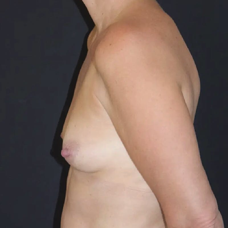 Breast Augmentation Before & After Gallery - Patient 248022 - Image 5