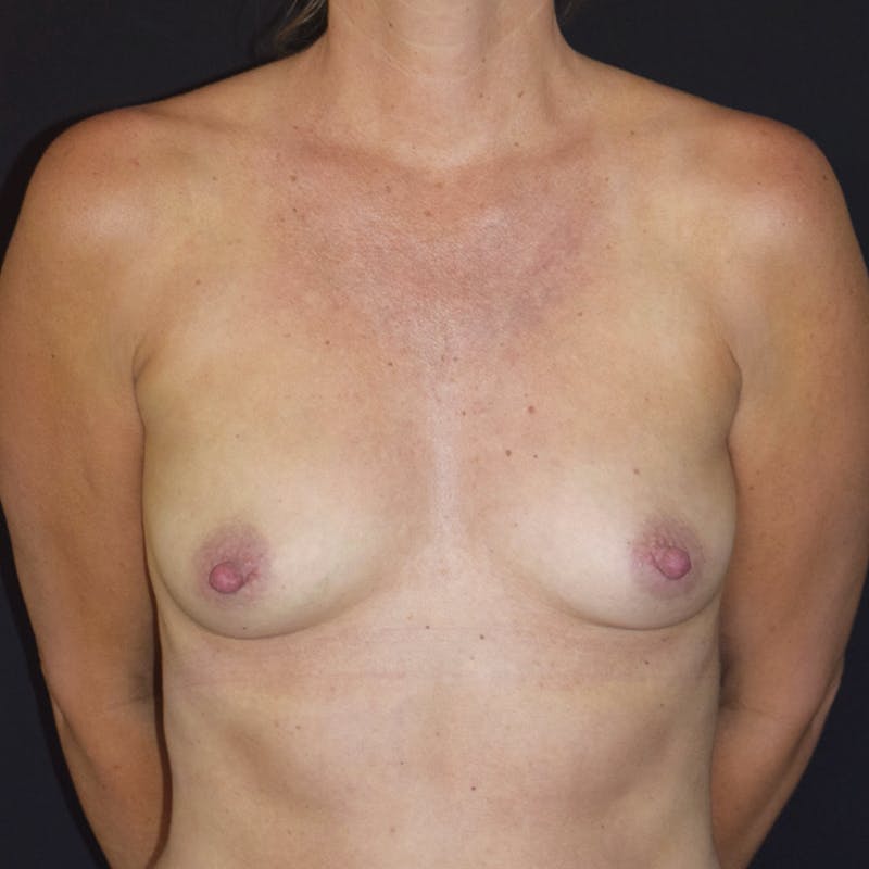 Breast Augmentation Before & After Gallery - Patient 248022 - Image 1