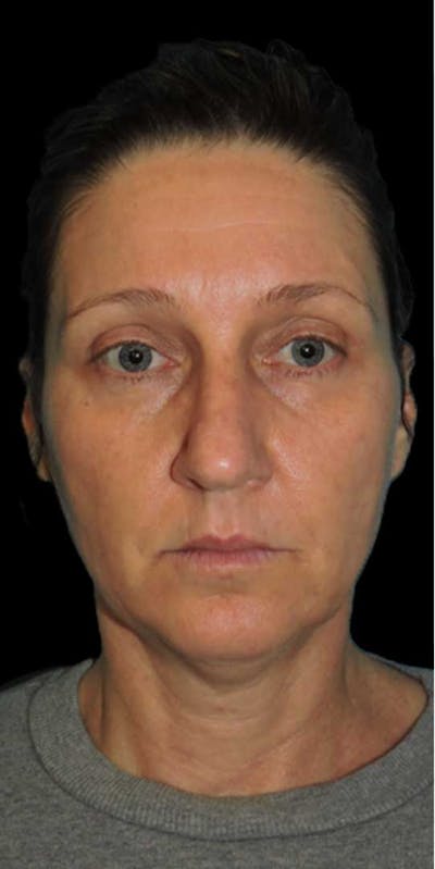 Facelift Before & After Gallery - Patient 313540 - Image 1