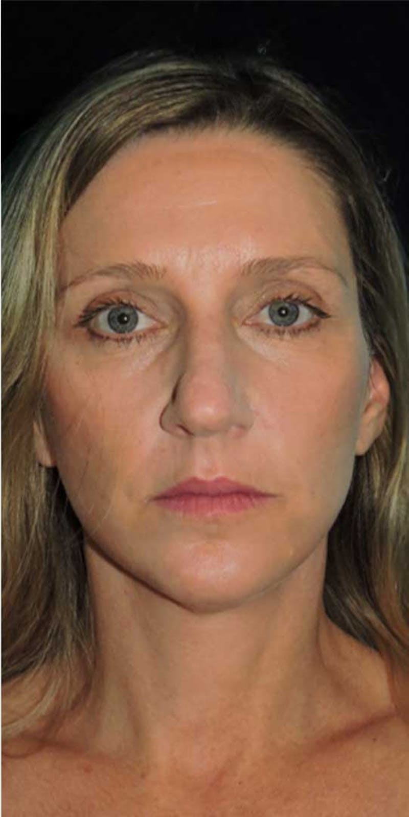 Facelift Before & After Gallery - Patient 313540 - Image 2