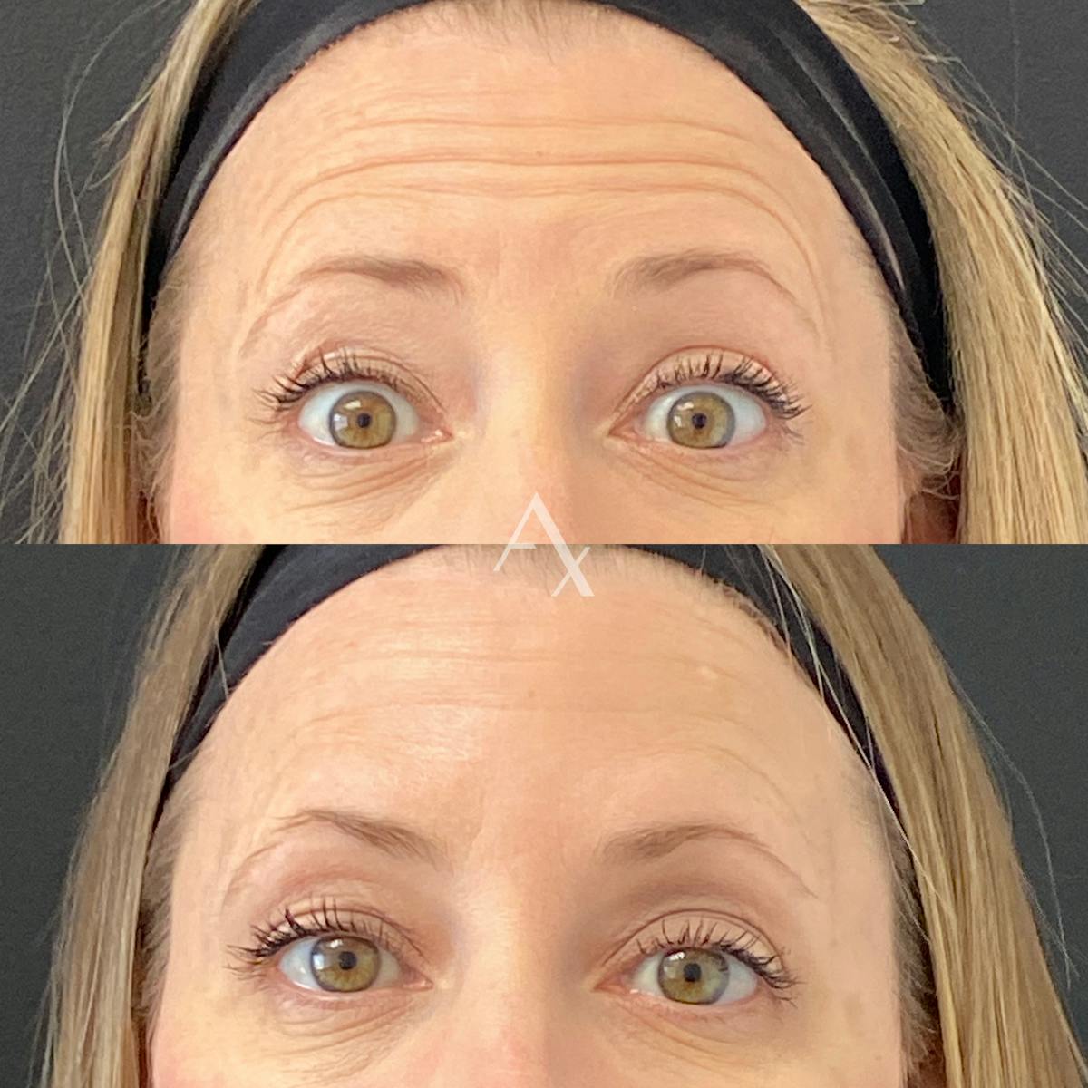 Botox Before & After Gallery - Patient 170343 - Image 1
