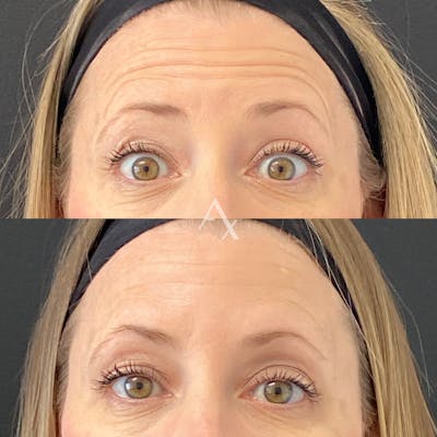 Botox Before & After Gallery - Patient 170343 - Image 1
