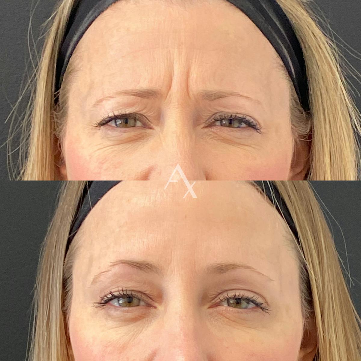 Botox Before & After Gallery - Patient 170343 - Image 2