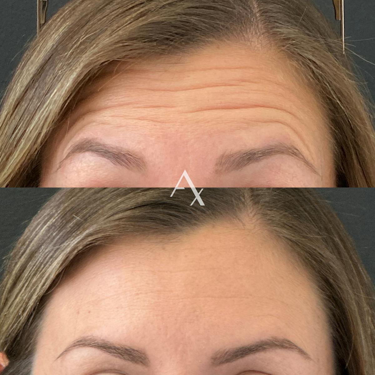 Botox Before & After Gallery - Patient 355444 - Image 1