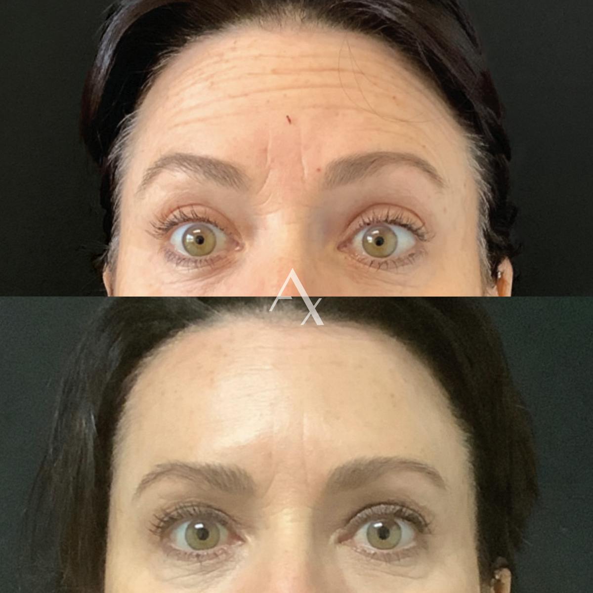 Botox Before & After Gallery - Patient 222697 - Image 1