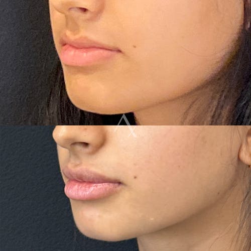 Aesthetx.com, real patient case result before and after image