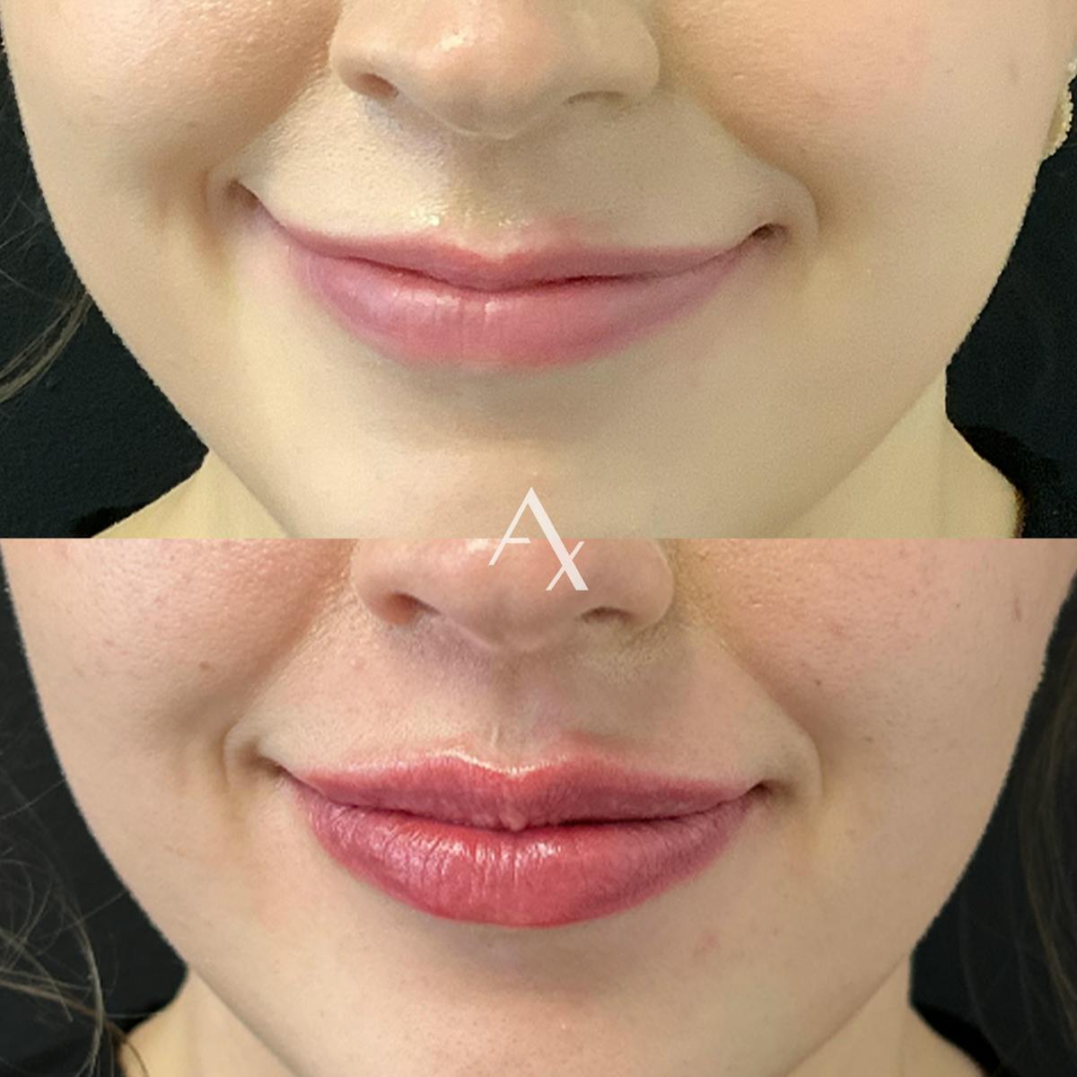 Dermal Fillers Before & After Gallery - Patient 316486 - Image 1