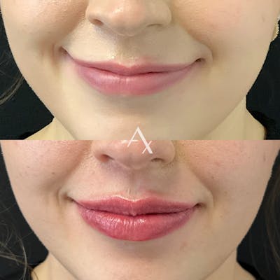 Dermal Fillers Before & After Gallery - Patient 316486 - Image 1