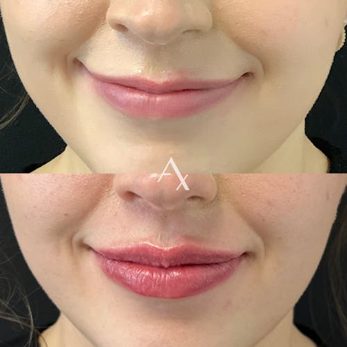 Aesthetx.com, real patient case result before and after image