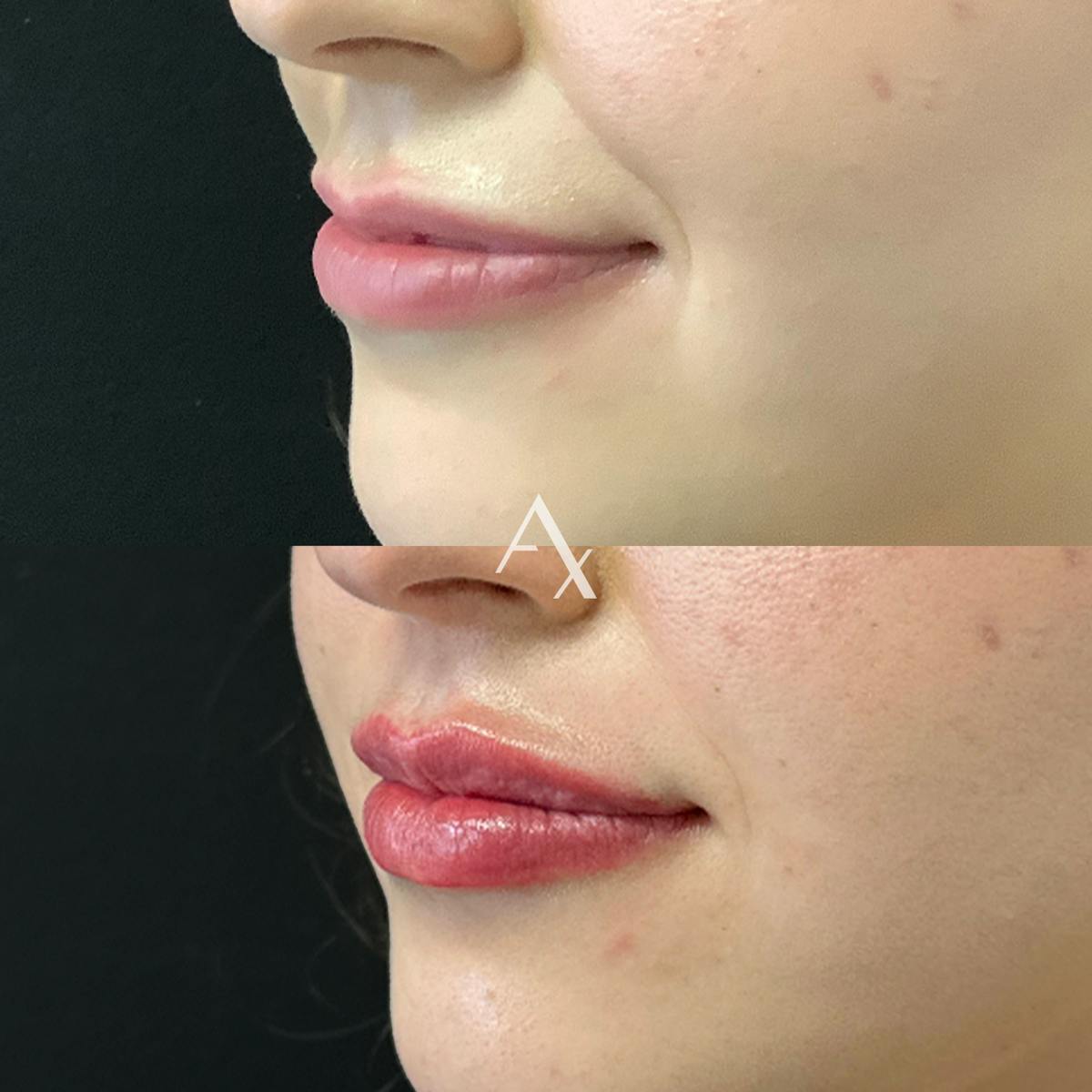 Dermal Fillers Before & After Gallery - Patient 316486 - Image 2