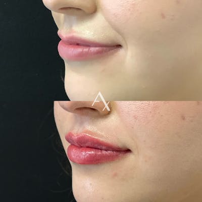 Dermal Fillers Before & After Gallery - Patient 316486 - Image 1