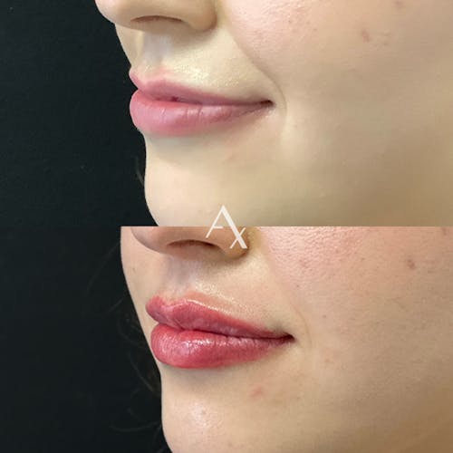 Aesthetx.com, real patient case result before and after image