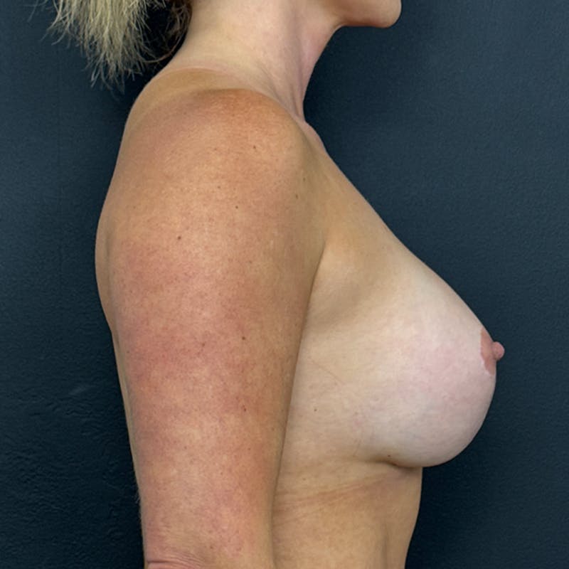 Preservé™ Breast Enhancement Before & After Gallery - Patient 157372 - Image 6