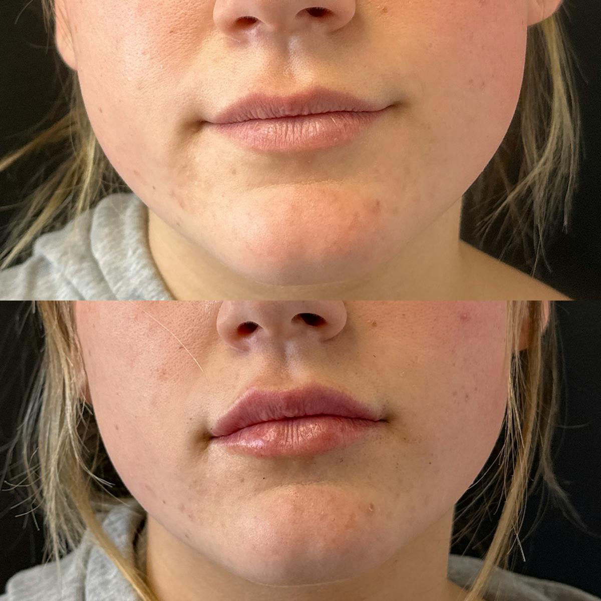Dermal Fillers Before & After Gallery - Patient 202262 - Image 1