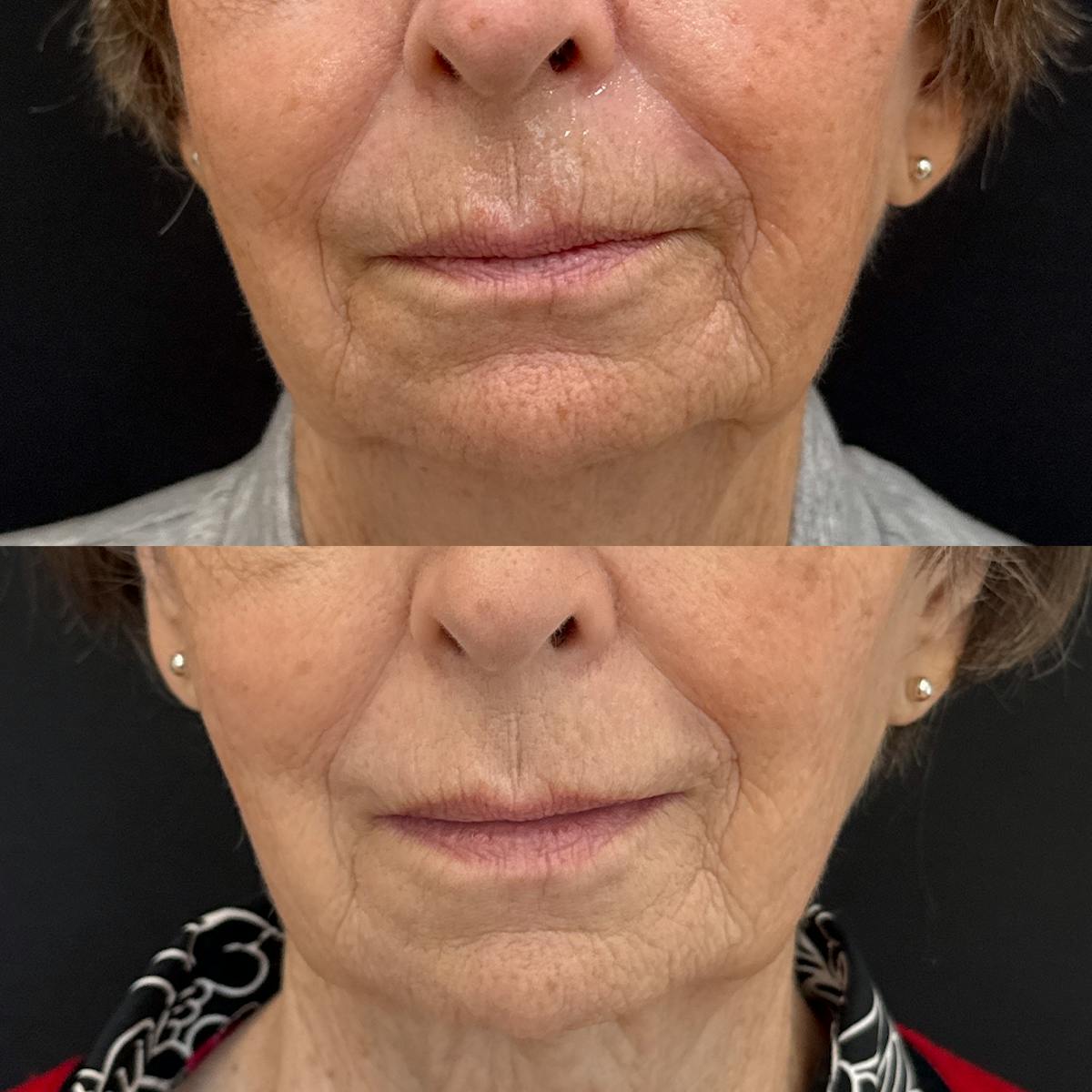 Dermal Fillers Before & After Gallery - Patient 141656 - Image 1