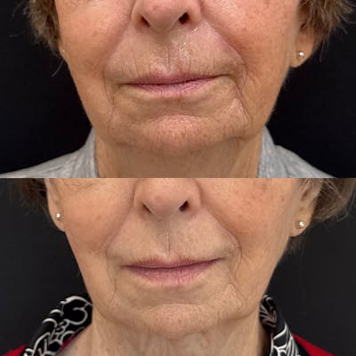 Dermal Fillers Before & After Gallery - Patient 141656 - Image 1