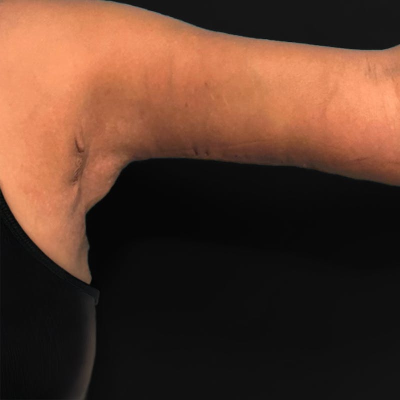 Brachioplasty Before & After Gallery - Patient 135328 - Image 2