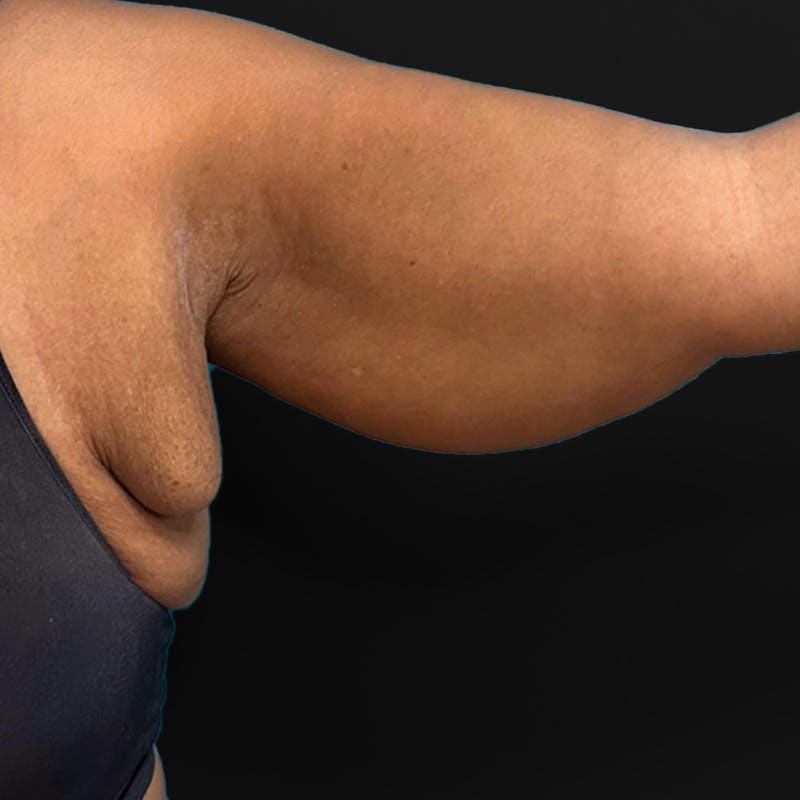 Brachioplasty Before & After Gallery - Patient 135328 - Image 1