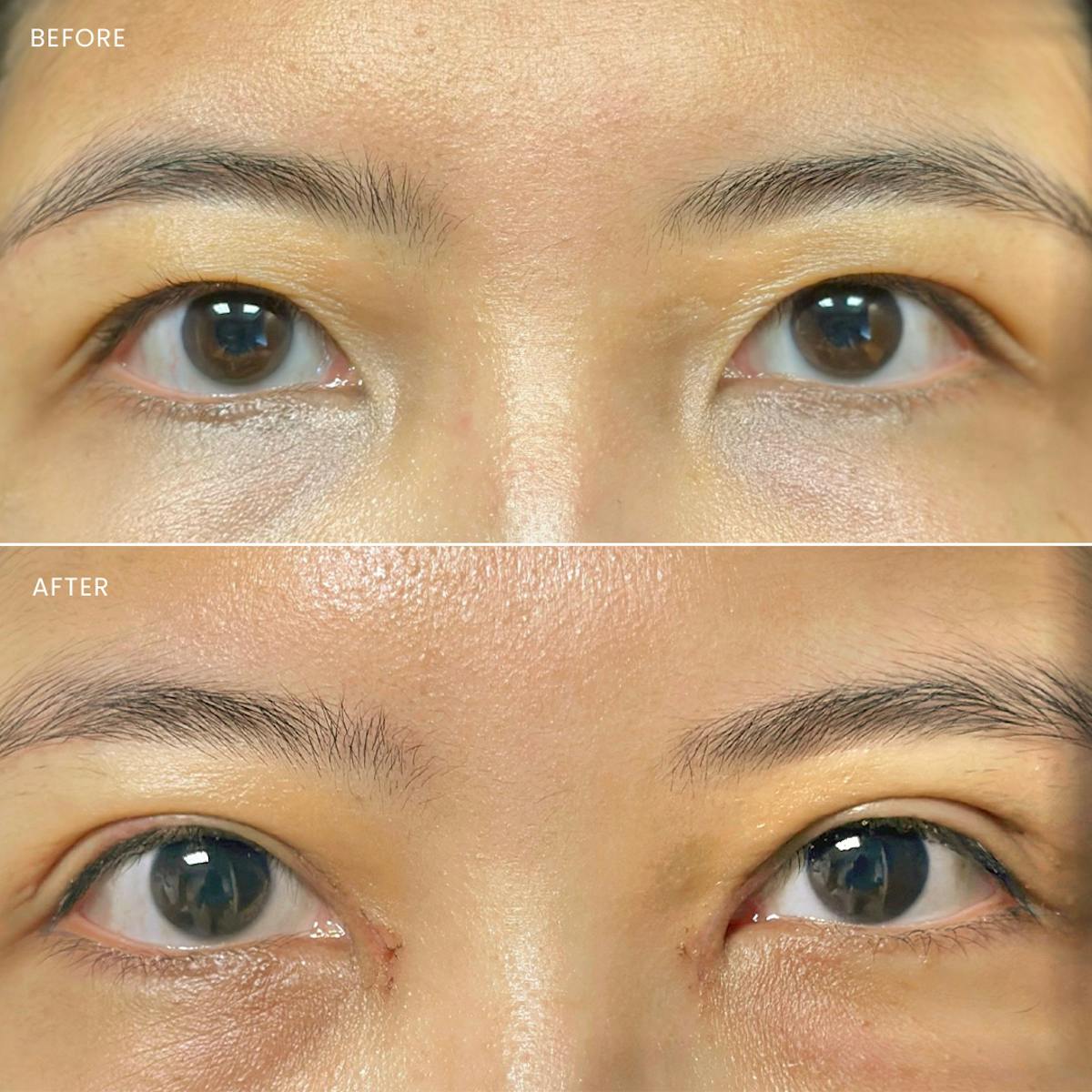 Eyelid Surgery (Blepharoplasty) Before & After Gallery - Patient 245565 - Image 1