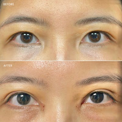 Eyelid Surgery (Blepharoplasty) Before & After Gallery - Patient 245565 - Image 1